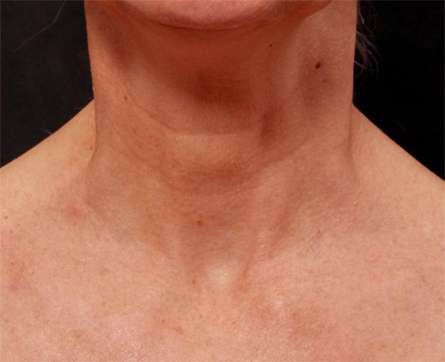 Real patient results before and after plastic surgery results in Glenview, IL, performed by Dr. Casas