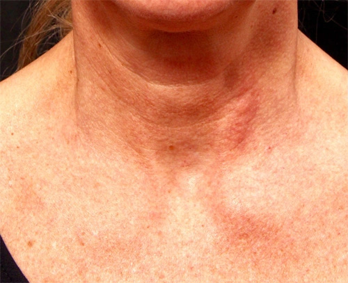 Real patient results before and after plastic surgery results in Glenview, IL, performed by Dr. Casas