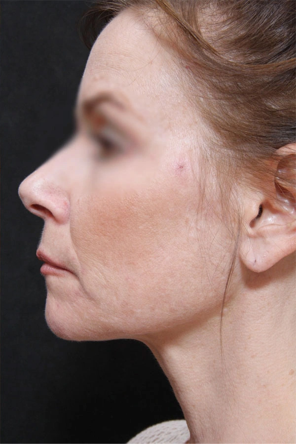 Real patient results before and after plastic surgery results in Glenview, IL, performed by Dr. Casas