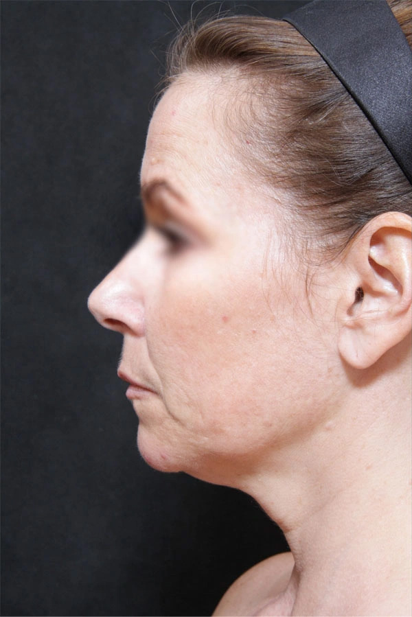Real patient results before and after plastic surgery results in Glenview, IL, performed by Dr. Casas