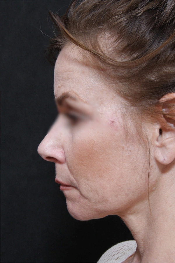 Real patient results before and after plastic surgery results in Glenview, IL, performed by Dr. Casas