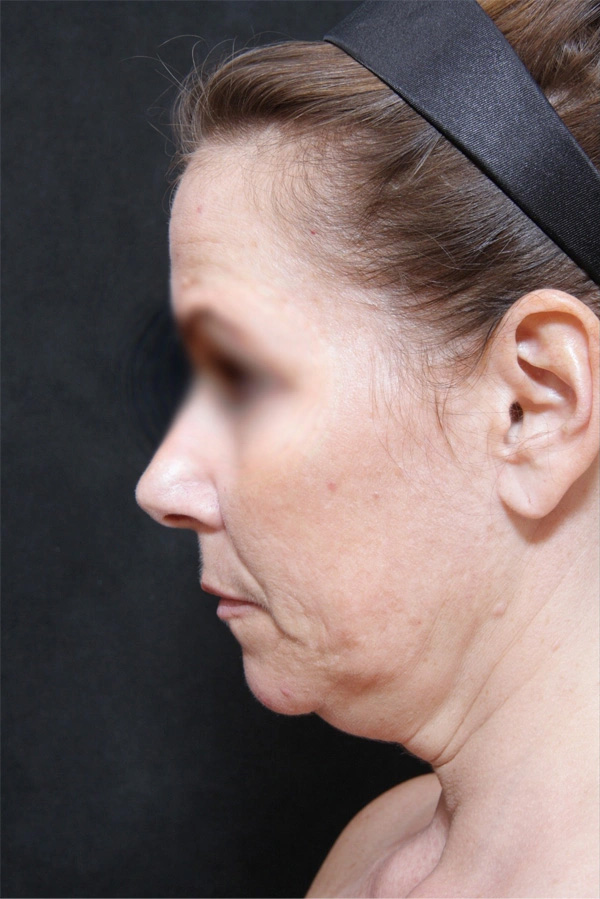 Real patient results before and after plastic surgery results in Glenview, IL, performed by Dr. Casas