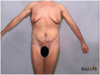 Real patient results before and after plastic surgery results in Glenview, IL, performed by Dr. Casas