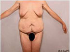 Real patient results before and after plastic surgery results in Glenview, IL, performed by Dr. Casas