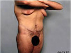 Real patient results before and after plastic surgery results in Glenview, IL, performed by Dr. Casas