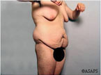 Real patient results before and after plastic surgery results in Glenview, IL, performed by Dr. Casas