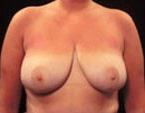Real patient results before and after plastic surgery results in Glenview, IL, performed by Dr. Casas