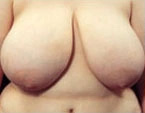 Real patient results before and after plastic surgery results in Glenview, IL, performed by Dr. Casas
