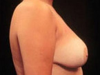Real patient results before and after plastic surgery results in Glenview, IL, performed by Dr. Casas