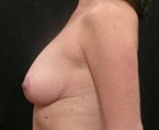 Real patient results before and after plastic surgery results in Glenview, IL, performed by Dr. Casas
