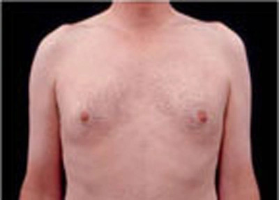 Real patient results before and after plastic surgery results in Glenview, IL, performed by Dr. Casas