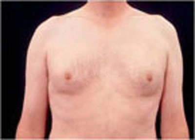 Real patient results before and after plastic surgery results in Glenview, IL, performed by Dr. Casas
