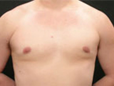 Real patient results before and after plastic surgery results in Glenview, IL, performed by Dr. Casas