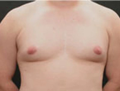 Real patient results before and after plastic surgery results in Glenview, IL, performed by Dr. Casas