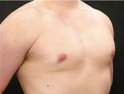 Real patient results before and after plastic surgery results in Glenview, IL, performed by Dr. Casas