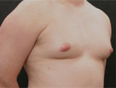 Real patient results before and after plastic surgery results in Glenview, IL, performed by Dr. Casas