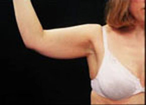 Real patient results before and after plastic surgery results in Glenview, IL, performed by Dr. Casas