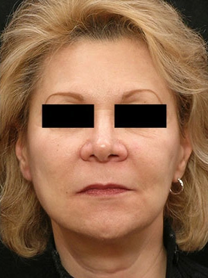 Real patient results before and after plastic surgery results in Glenview, IL, performed by Dr. Casas