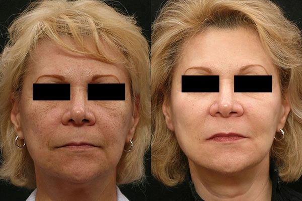 Real patient results before and after plastic surgery results in Glenview, IL, performed by Dr. Casas