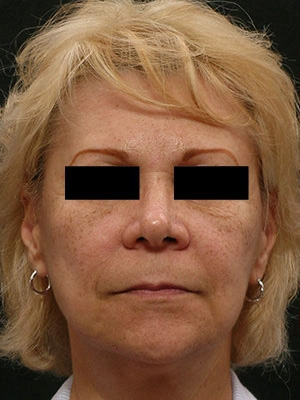 Real patient results before and after plastic surgery results in Glenview, IL, performed by Dr. Casas