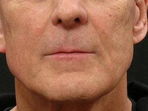 Real patient results before and after plastic surgery results in Glenview, IL, performed by Dr. Casas
