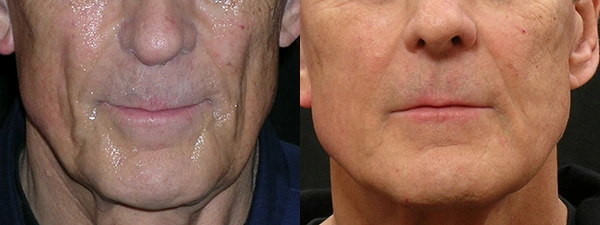Real patient results before and after plastic surgery results in Glenview, IL, performed by Dr. Casas