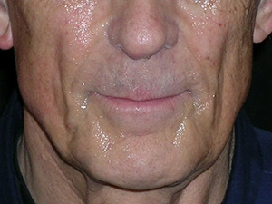 Real patient results before and after plastic surgery results in Glenview, IL, performed by Dr. Casas