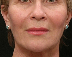 Real patient results before and after plastic surgery results in Glenview, IL, performed by Dr. Casas