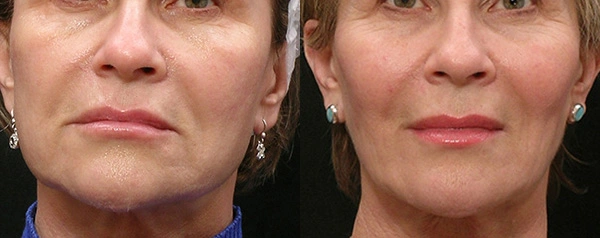 Real patient results before and after plastic surgery results in Glenview, IL, performed by Dr. Casas