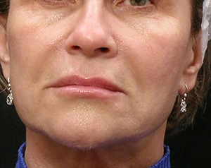 Real patient results before and after plastic surgery results in Glenview, IL, performed by Dr. Casas