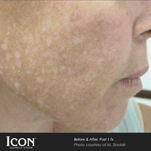 Real patient results before and after plastic surgery results in Glenview, IL, performed by Dr. Casas