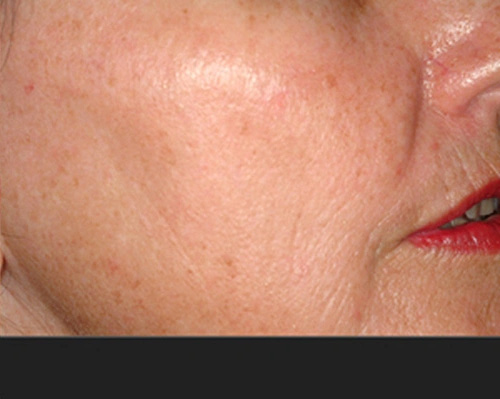 Real patient results before and after plastic surgery results in Glenview, IL, performed by Dr. Casas