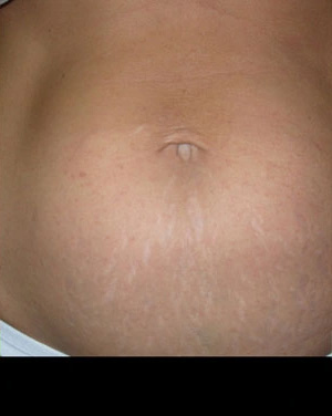 Real patient results before and after plastic surgery results in Glenview, IL, performed by Dr. Casas