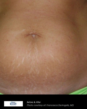 Real patient results before and after plastic surgery results in Glenview, IL, performed by Dr. Casas