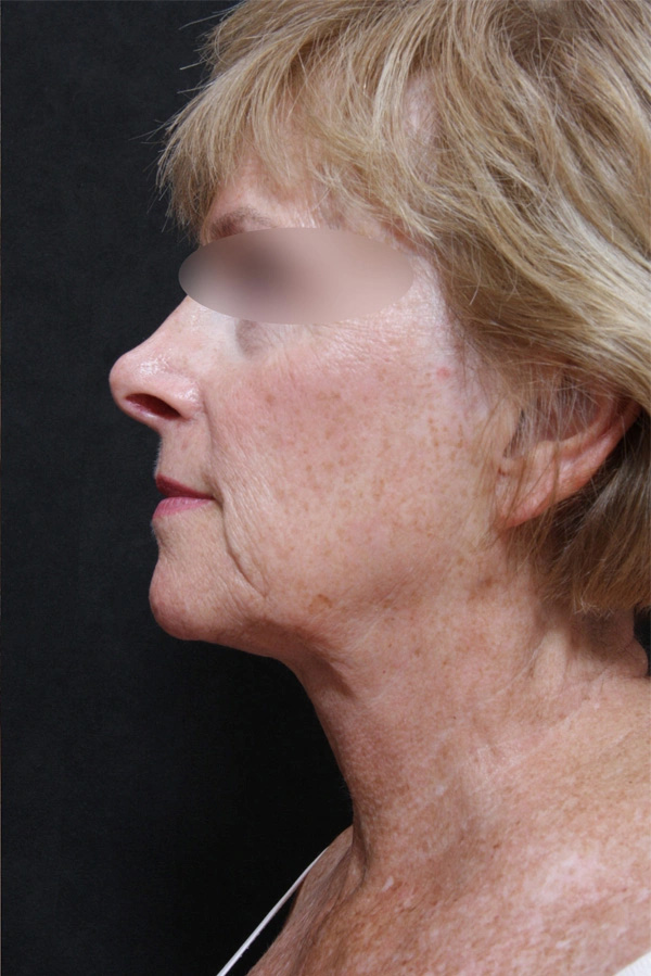 Real patient results before and after plastic surgery results in Glenview, IL, performed by Dr. Casas