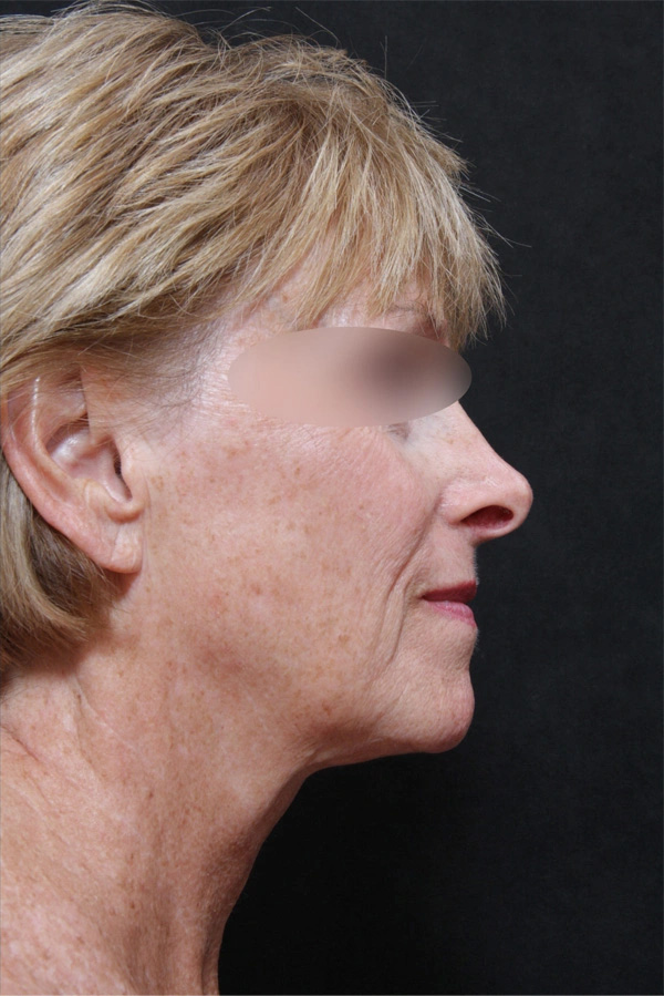 Real patient results before and after plastic surgery results in Glenview, IL, performed by Dr. Casas