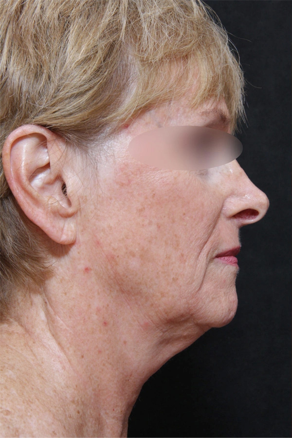 Real patient results before and after plastic surgery results in Glenview, IL, performed by Dr. Casas