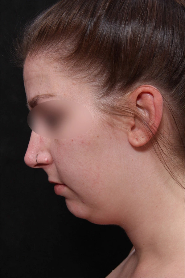 Real patient results before and after plastic surgery results in Glenview, IL, performed by Dr. Casas