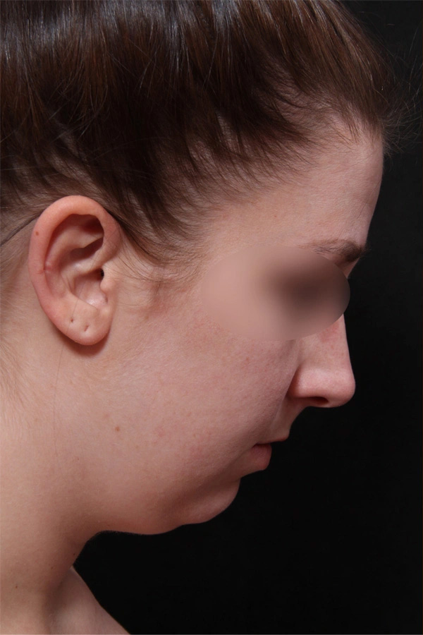 Real patient results before and after plastic surgery results in Glenview, IL, performed by Dr. Casas
