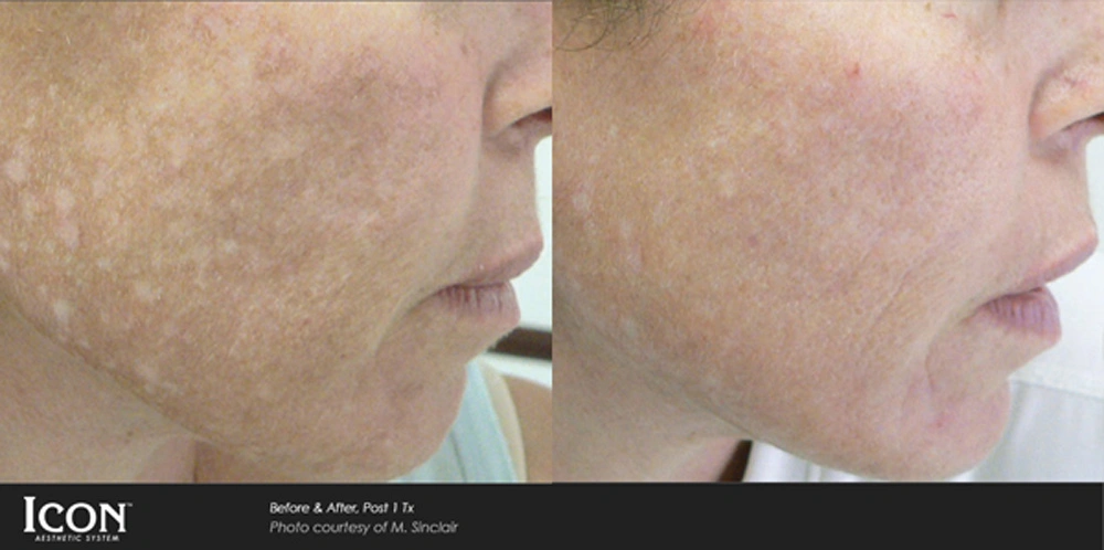 Real patient results before and after plastic surgery results in Glenview, IL, performed by Dr. Casas