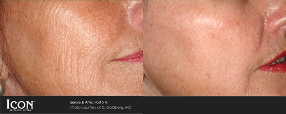 Real patient results before and after plastic surgery results in Glenview, IL, performed by Dr. Casas