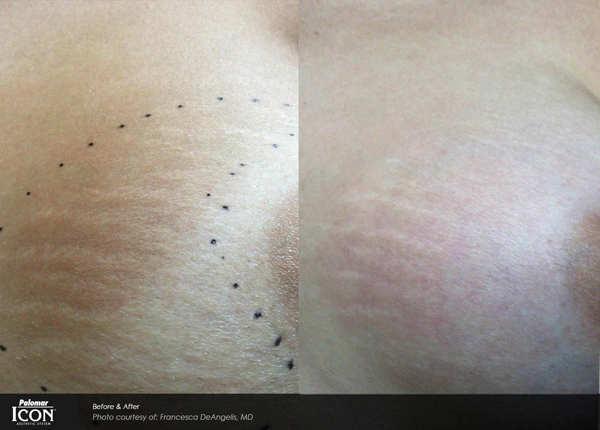 Real patient results before and after plastic surgery results in Glenview, IL, performed by Dr. Casas