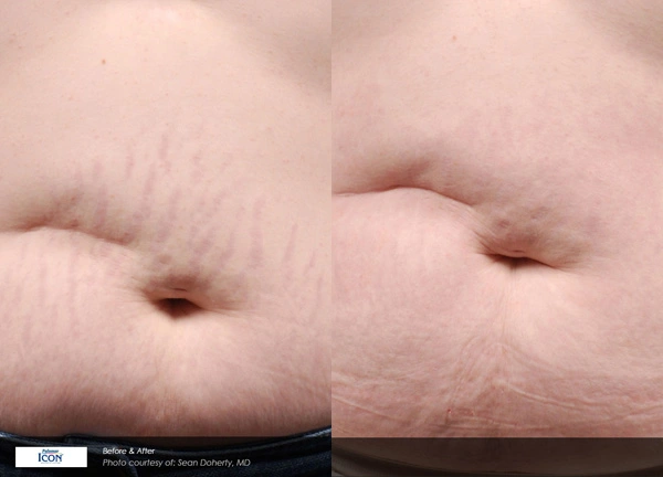 Real patient results before and after plastic surgery results in Glenview, IL, performed by Dr. Casas