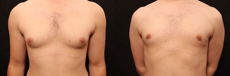 Real patient results before and after plastic surgery results in Glenview, IL, performed by Dr. Casas