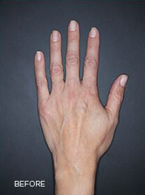 Hand Rejuvenation with Dermal Fillers