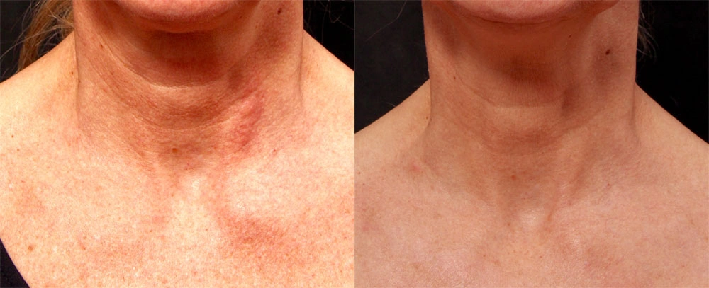 Real patient results before and after plastic surgery results in Glenview, IL, performed by Dr. Casas