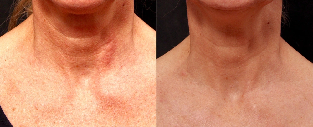 Real patient results before and after plastic surgery results in Glenview, IL, performed by Dr. Casas