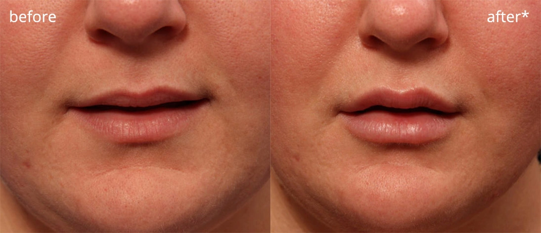 Real patient results before and after plastic surgery results in Glenview, IL, performed by Dr. Casas