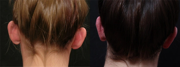 Real patient results before and after plastic surgery results in Glenview, IL, performed by Dr. Casas