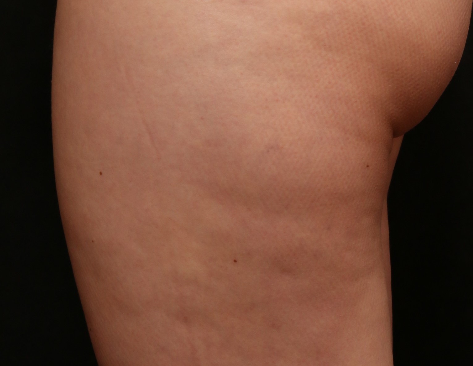 Post Aveli after photo - Left Lateral Thigh